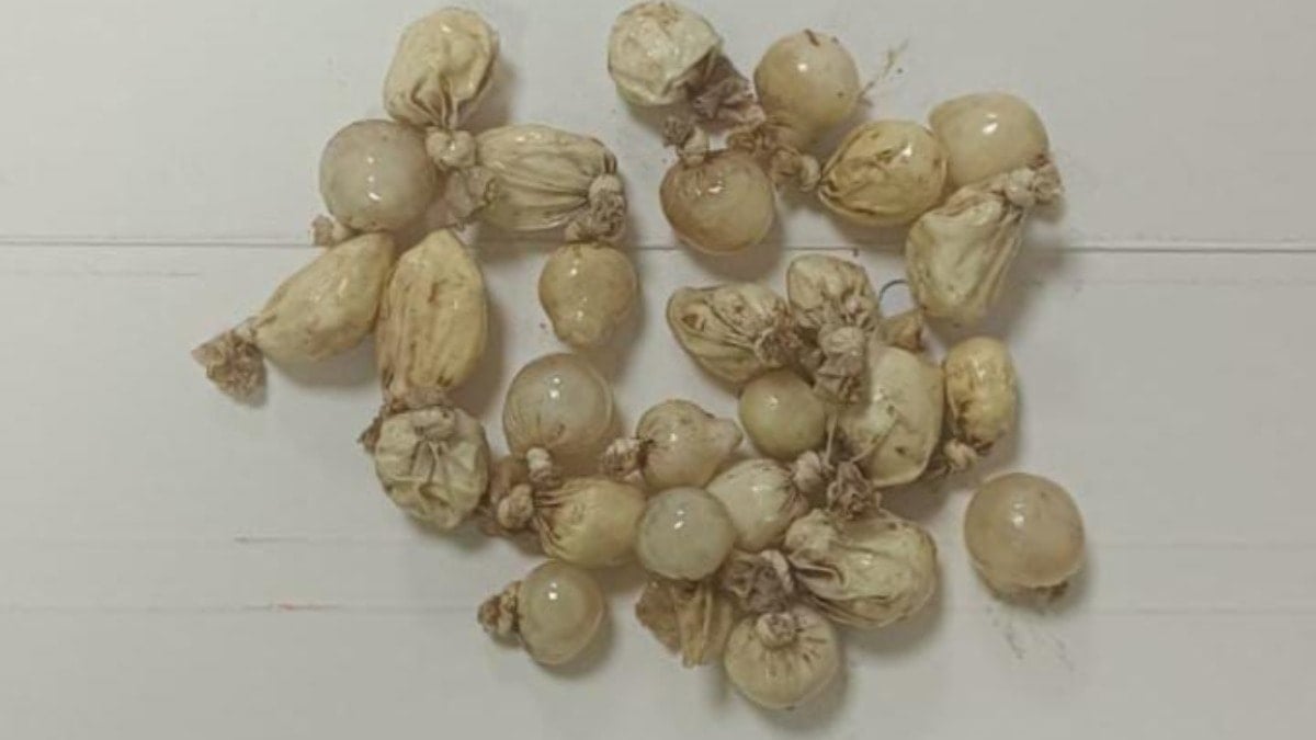 Alkollü sanıldı, midesinden 27 kapsül uyuşturucu çıktı Alkollü sanıldı, midesinden 27 kapsül uyuşturucu çıktı